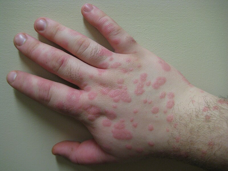 File:Erythema multiforme minor of the hand.jpg