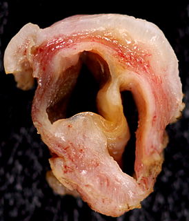 <span class="mw-page-title-main">Gartner's duct cyst</span> Medical condition