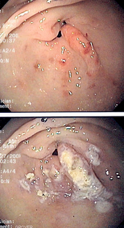صورة بالمنظار لتوسع أوعية غار المعدة، يظهر التوسع بمنظر شعاعي حول البواب. قبل العلاج (الصورة في الأعلى) وبعد العلاج بواسطة تخثير البلازما بالأرغون (الصورة في الأسفل).