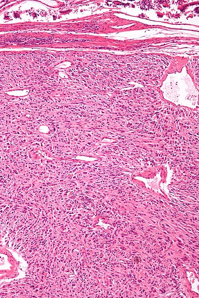 File:Gastrointestinal stromal tumour - deep - intermed mag.jpg