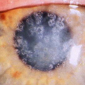 Granular corneal dystrophy type I. Numerous irregular shaped discrete crumb-like corneal opacities.JPEG