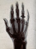 Röntgenfotografi av Schuster föreställande en hand (med ring).