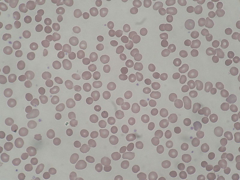 File:Hereditary Spherocytosis smear 2010-03-17.JPG