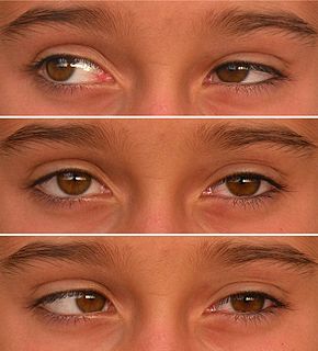 Duane syndrome Rare congenital disease characterized by external gaze palsy