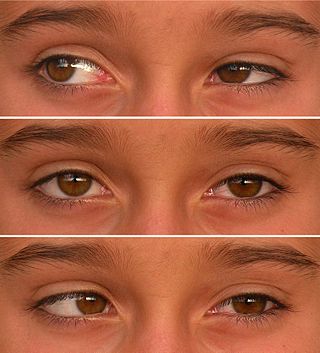 <span class="mw-page-title-main">Duane syndrome</span> Rare congenital disease characterized by external gaze palsy