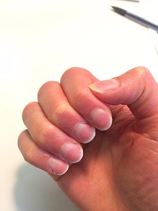 <span class="mw-page-title-main">Half and half nail</span> Medical condition