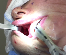 Mid facelift (rhytidectomy) lower incision.png
