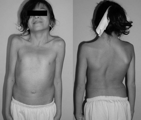 12-летняя девочка с синдромом Нунан — Типичная перепончатая шея.