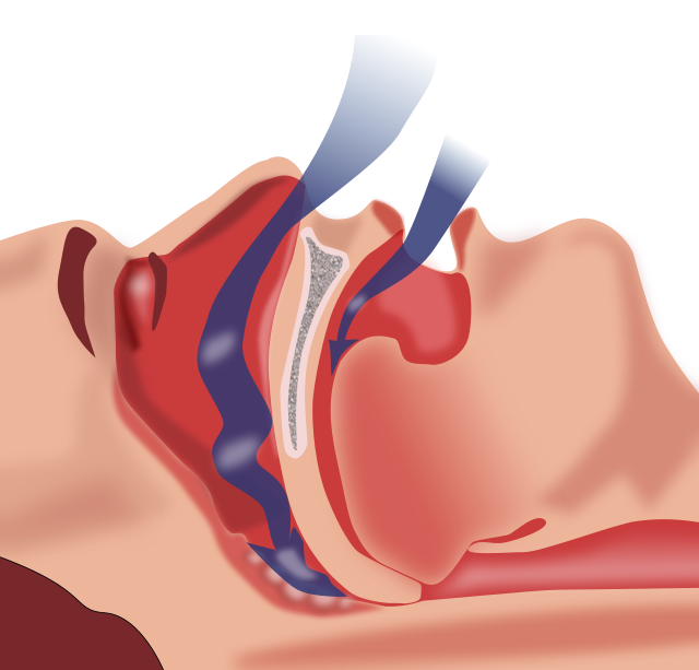 El tratamiento de la apnea del sueño con dispositivos de avance mandibular  presenta más adherencia que la CPAP