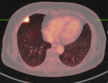 PET-CT of a tuberculoma.