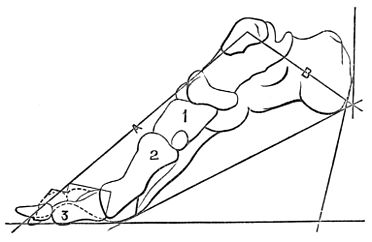 PSM V24 D673 Deforming pressure of high heels on the foot bone structure.jpg