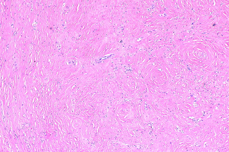 File:Paratesticular fibrous pseudotumour - alt -- low mag.jpg