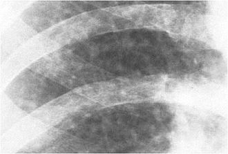 Close-up right upper zone 2/2 R/R Silicosis.ILO Classification 2-2 R-R.jpg