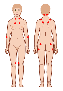 Fibromyalgia Chronic disorder of unknown cause characterized by pain, stiffness, and widespread tenderness in muscles