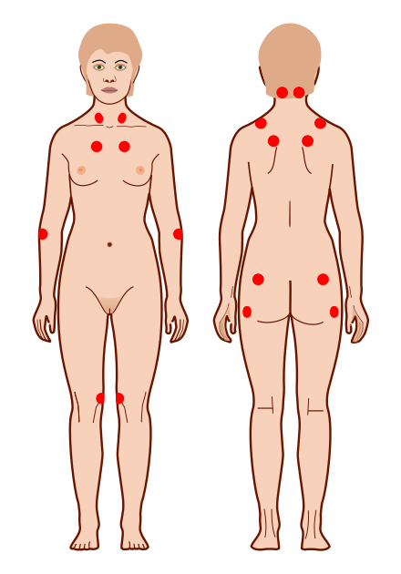 The location of the nine paired tender points that comprise the 1990 American College of Rheumatology criteria for fibromyalgia