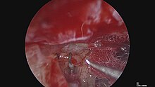 The Stapes in Otosclerosis: Osteoarthritis of an Ear Ossicle