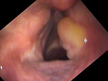 Granuloma of the vocal cord Vocal cord granuloma.jpg