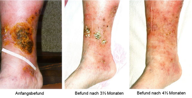 Healing process of a chronic venous stasis ulcer of the lower leg