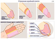 Интимное воспаление: что такое баланопостит и как его лечат