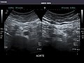 Abdominal Ultrasound Full Exam 44.jpg