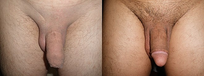 Penis before and after circumcision