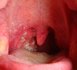 salaris meel analoog Tonsillitis - Wikipedia