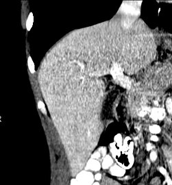 A CT scan in which the liver and portal vein are shown