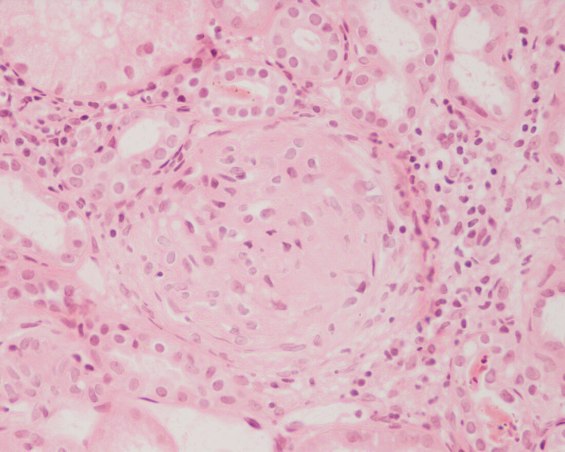 Glomerulonephritis