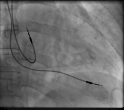 Szívritmus-Szabályozó: A pacemaker története, A szívritmus-szabályozás módjai, Alapvető funkció