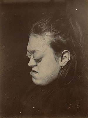 Girl aged 17 years with marked proptosis Wellcome L0062481.jpg