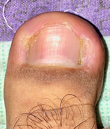 Ingrown nail - Wikipedia