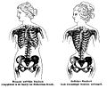 Langkabel1892 Verkrüppelung des weiblichen Brustkastens durch Korsett.jpg