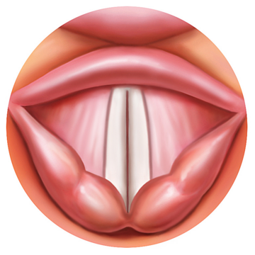 Laryngospasm