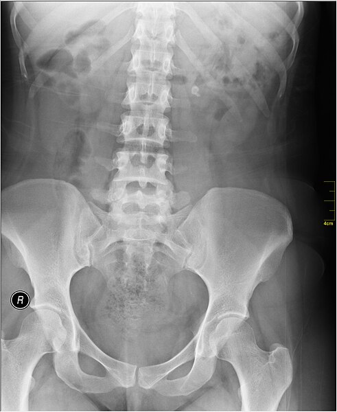 File:Medical X-Ray imaging STK07 nevit.jpg