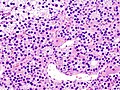 Parathyroid adenoma histopathology (3).jpg