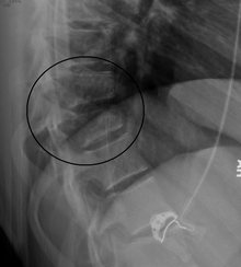 A flexion-distraction fracture of T10 and fracture of T9 due to a seatbelt during an MVC. PchancefracX.png