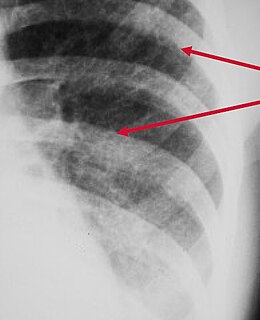 Peribronchial cuffing radiologic sign which occurs when excess fluid or mucus buildup in the small airway passages of the lung causes localized patches of atelectasis