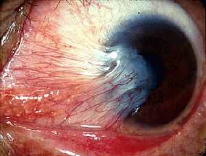 Pterygium (from Michigan Uni site, CC-BY).jpg