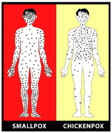 220px-Smallpox_%28variola_orthopox_virus_%29_Early_Rash_vs_chickenpox.gif