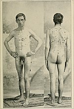 Thumbnail for File:A manual of syphilis and the venereal diseases, (1900) (14782161352).jpg