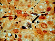 B. quintana and Mycobacterium avium complex coinfecting an AIDS patient Bacteria on Warthin-Starry stain.jpg