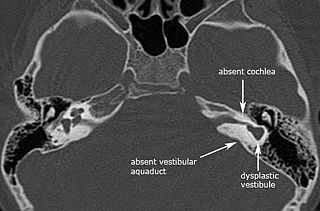 Michel aplasia congenital abnormality of the inner ear