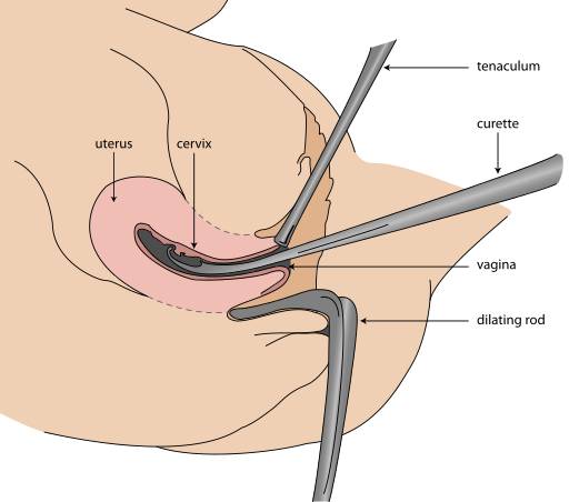 File:Dilation and curettage.svg