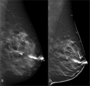 Full-field digital (FFD)-galactography and Digital breast tomosynthesis (DBT)-galactography.png