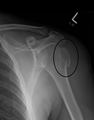 A fracture of the greater tubercle as seen on AP X ray