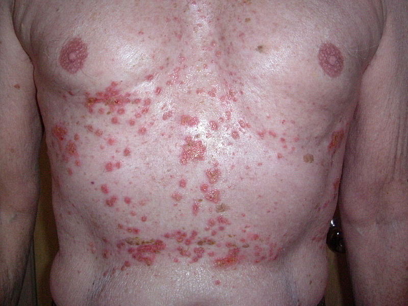 File:Grover's disease, advanced case.JPG