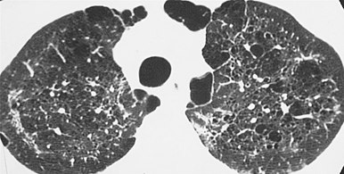 HRCT of cysts of pneumocystis pneumonia. These are usually multiple and bilateral, but range in size, shape and distribution.[6]