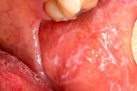 Classic Wickham's striae of non-erosive lichen planus in the left buccal mucosa