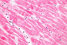 Micrograph of a myocardial infarction (ca. 400x H&E stain ) with prominent contraction band necrosis. MI with contraction bands very high mag.jpg