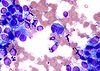 Melanom - cytologie pole stain.jpg